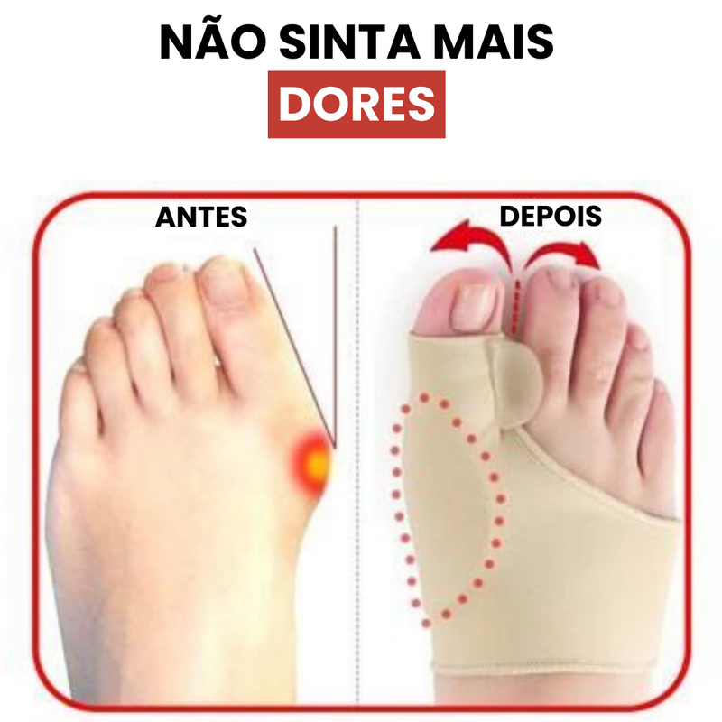 Corretor de Joanetes AlinhaFlex - COMPRE 1 E LEVE 2!